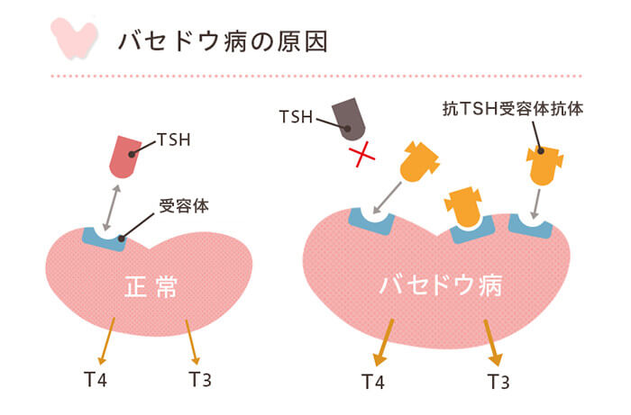 バセドウ病の原因図