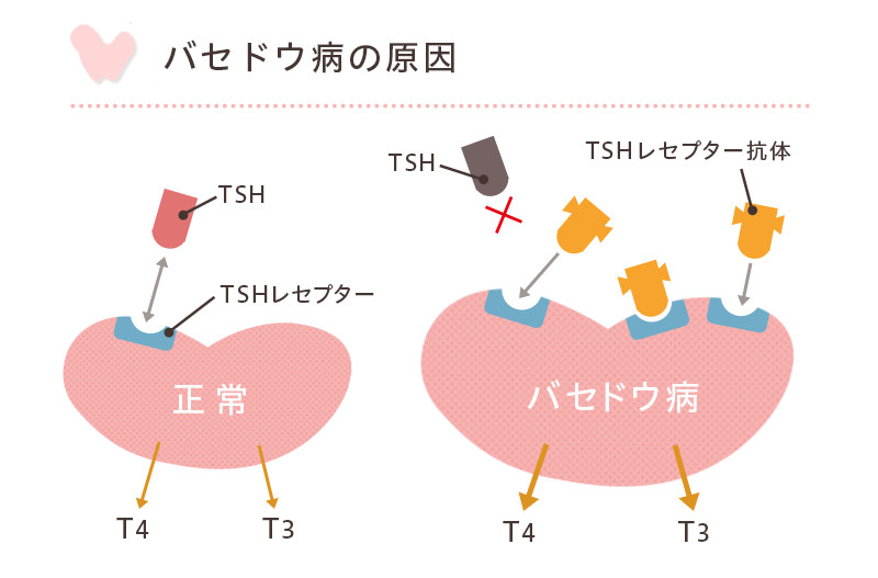 バセドウ病について 原因と症状 金地病院